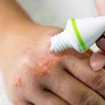 اگزما و کرونا ویروس؛ شستشوی دست در افراد مبتلا به بیماری پوستی